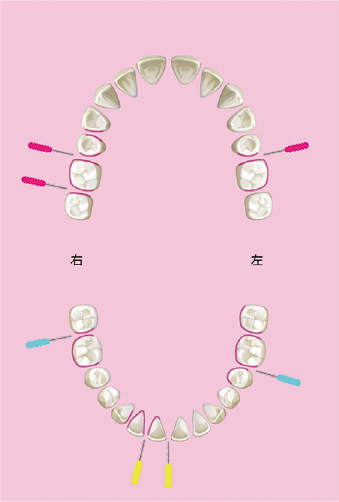 歯間ブラシの形状2