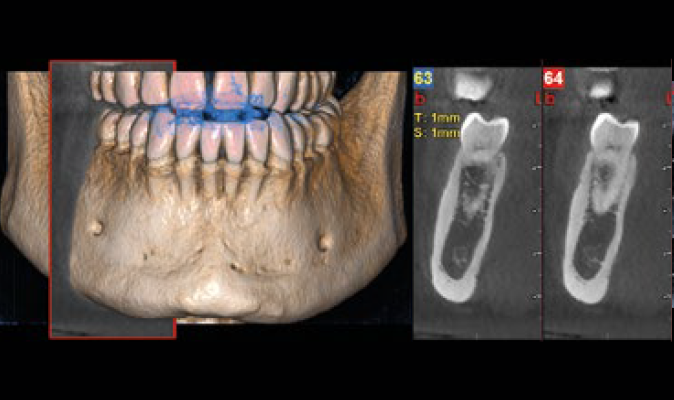 顎歯列/下顎歯列
